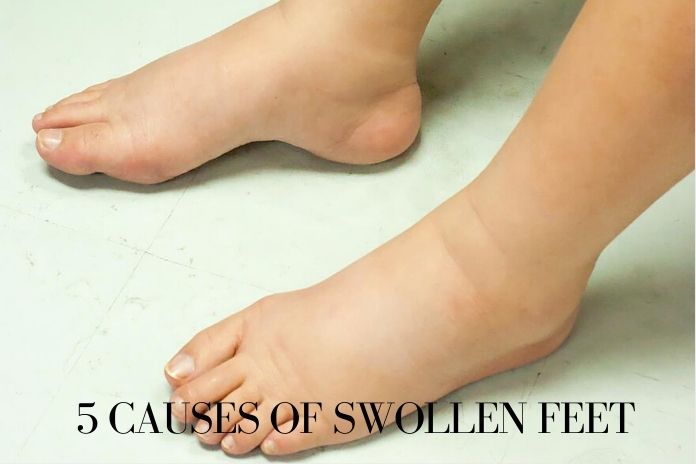 Swollen Feet 5 Possible Causes