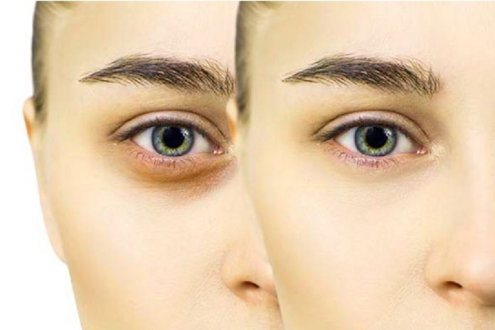 The Best Tips Against Shadows Under The Eyes