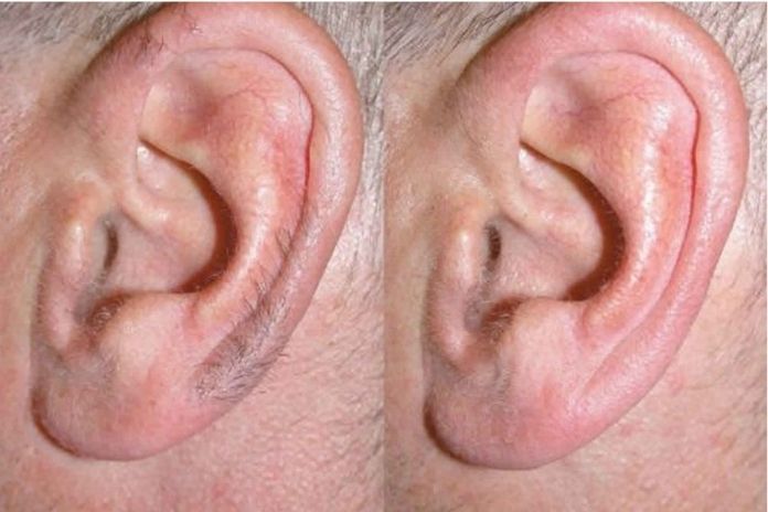 This Is How You Get Rid Of Annoying Hair In Your Ears
