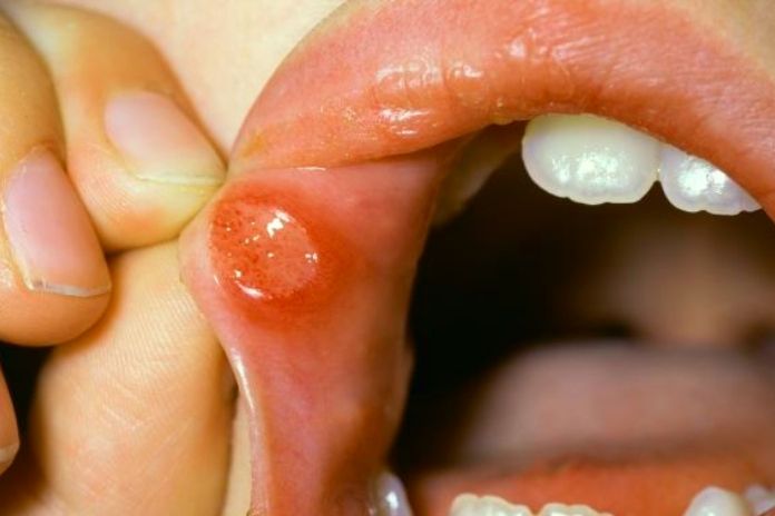 Stomatitis, Symptoms, And Natural Remedies