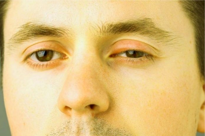 Swollen Eyelids Causes And Treatments