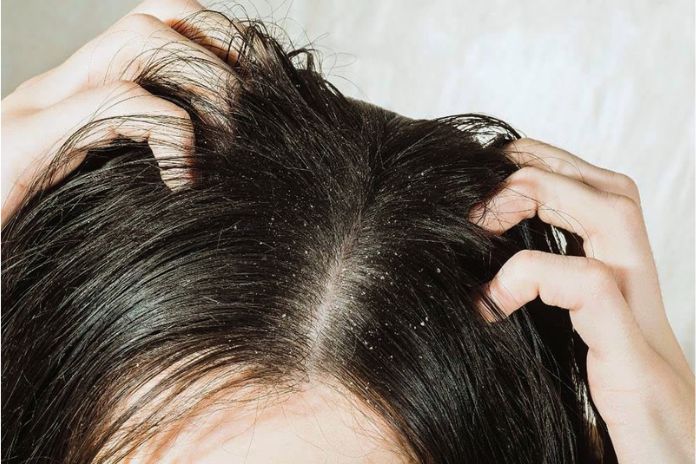 Nine Homemade Products To Get Rid Of Dandruff Naturally