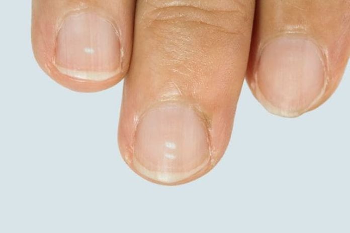 Hair Loss And Weak Nails Causes, Treatments