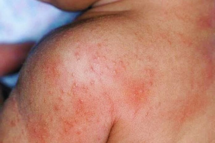 Sweat Dermatitis Or Sudamina