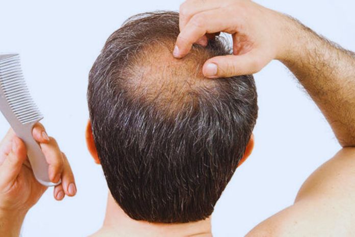 Hair Loss Causes And The Best Remedies To Combat It
